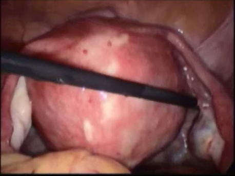 hysteroscopic surgery - 17 - a huge submucous fibroid extending to the outer serosal surface of the uterus type 2